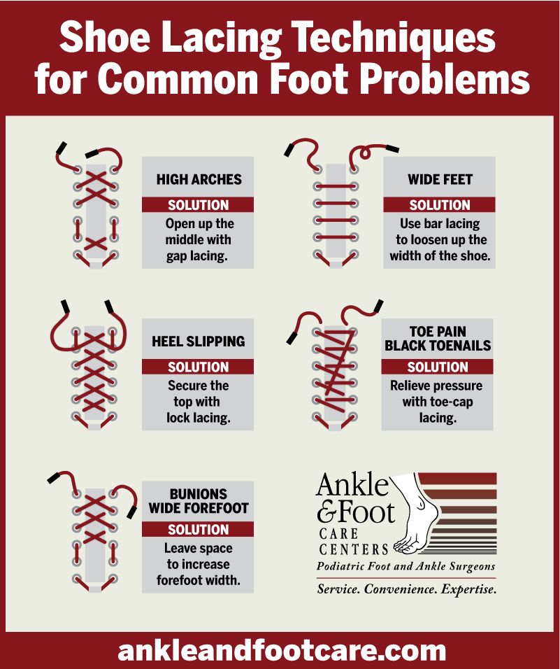 How to Lace Shoes for High Arches | Easy Guide for Support